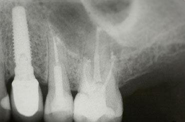 Root Canal Treatment by The St.Peter's Dental Practice