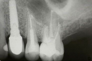 Root Canal Treatment by The St.Peter's Dental Practice