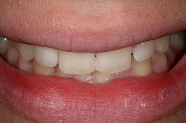 Crowns by The St.Peter's Dental Practice