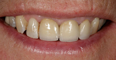 Image of Implant Dentistry