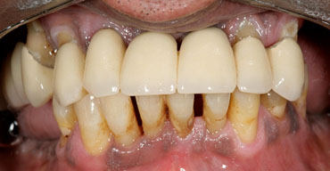 Image of treatment by The St.Peter's Dental Practice