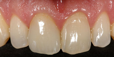Image of treatment by The St.Peter's Dental Practice