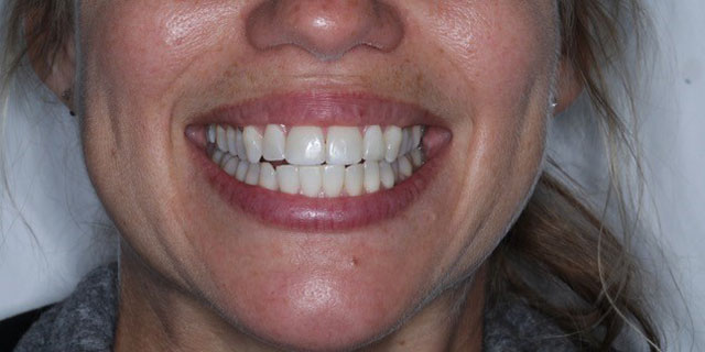 Image of Invisalign orthodontic treatment