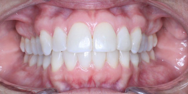 Image of Invisalign orthodontic treatment